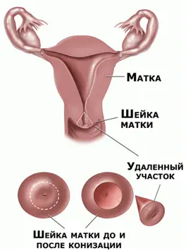Операция конизация шейки матки
