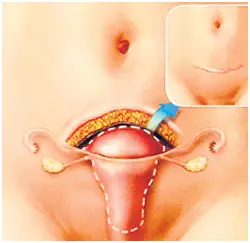 Удаление матки