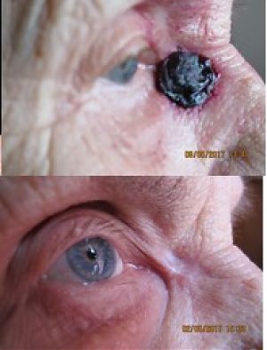 Отзыв о лечении базалиомы кожи на лице