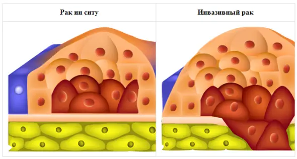 Диагностика рака шейки матки