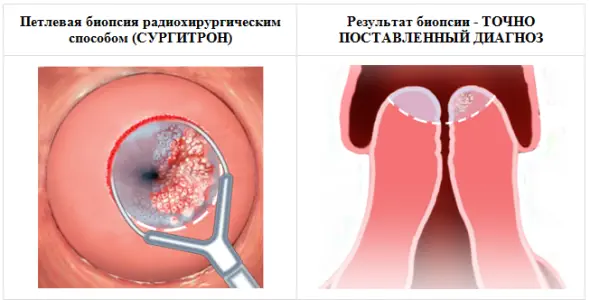 биопсия