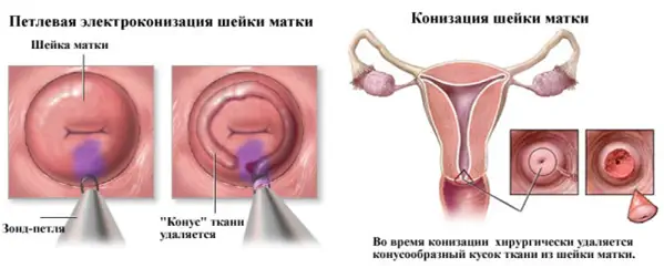 конизация шейки матки