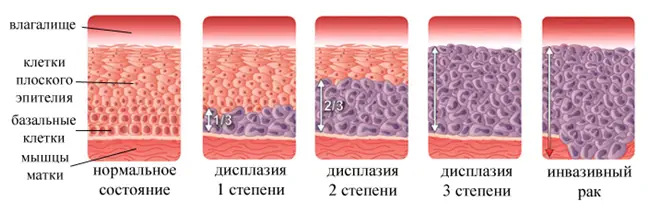 дисплазия 3 степени