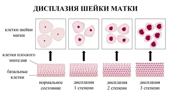 нормальные и атипичные клетки на разных стадиях дисплазии шейки матки
