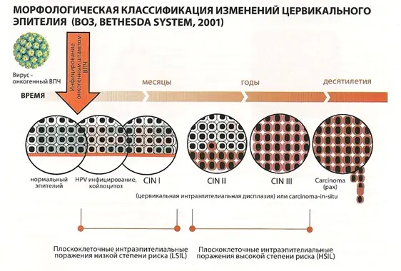 морфологическая классификация изменений цервикального эпителия