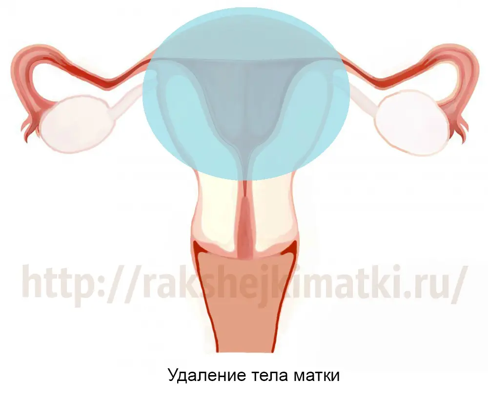 Удаление матки без шейки. Последствия надвлагалищной ампутации матки без придатков