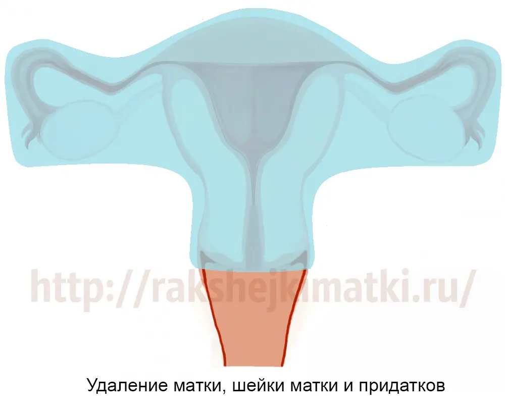 Удаление матки с придатками