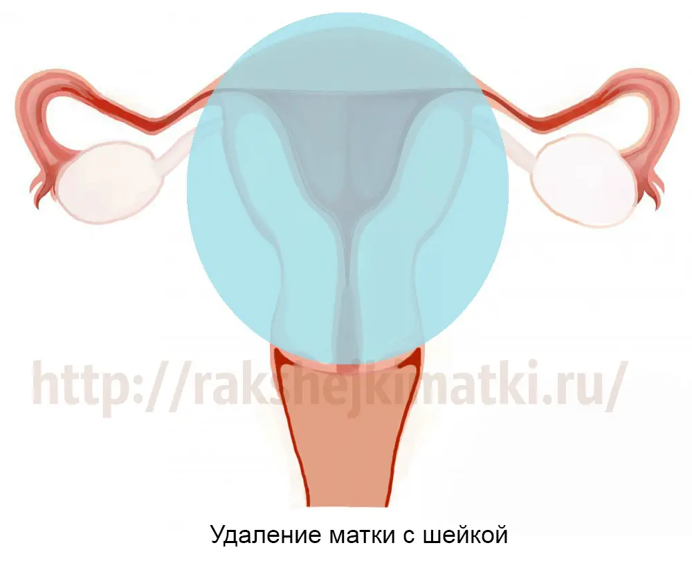 Удаление матки без яичников. Последствия экстирпации матки без придатков