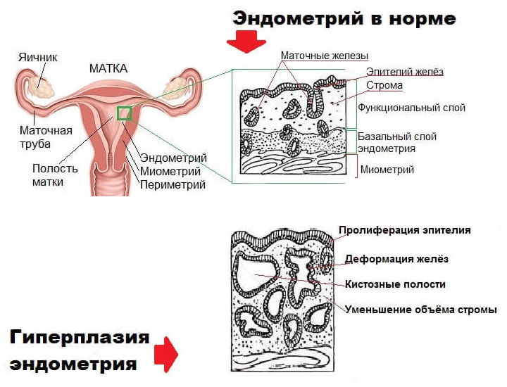 гиперплазия эндометрия