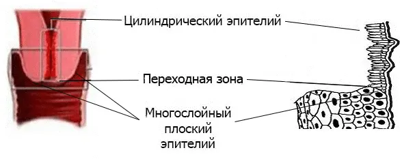 Неинвазивный рак шейки матки