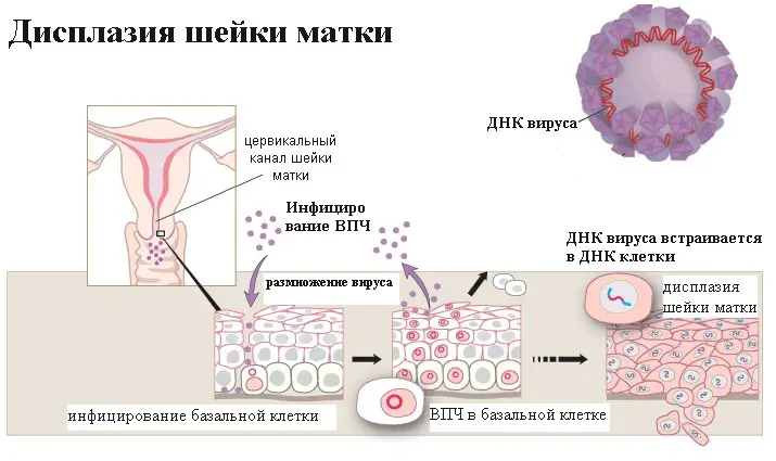 Дисплазия шейки матки