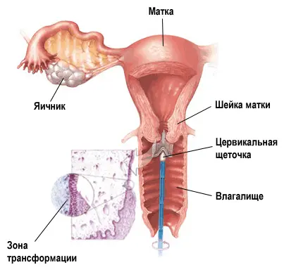 щетка позволяет взять клетки для анализа со всей окружности шейки матки и из цервикального канала