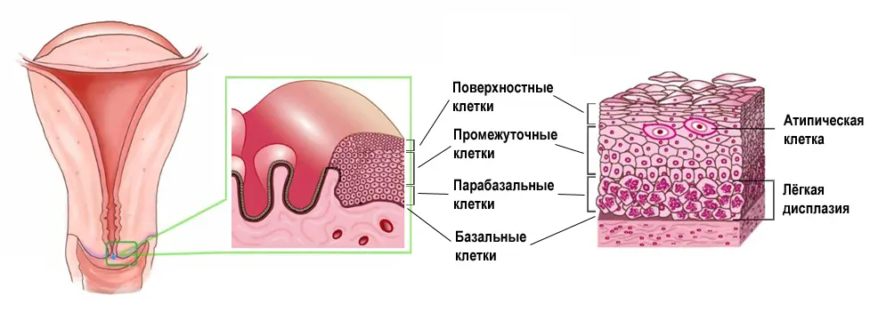 Трансформация клеток и атипические клетки на начальных стадиях дисплазии