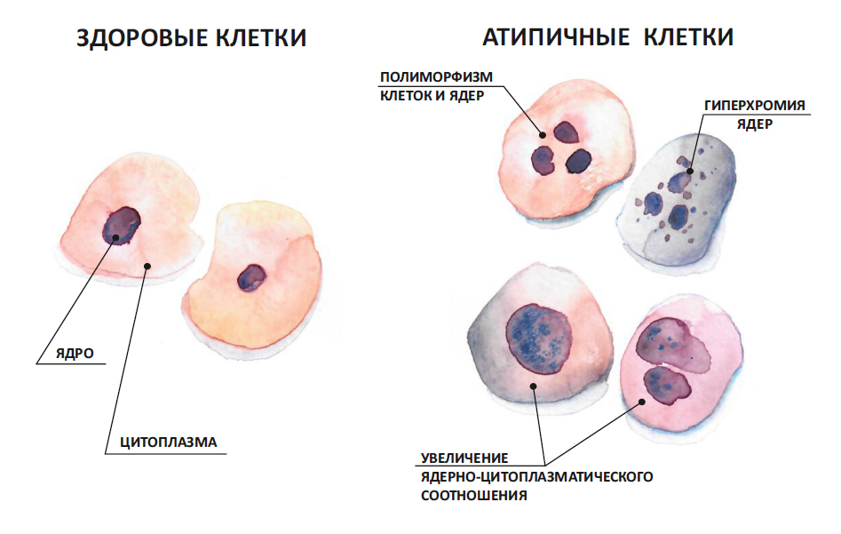 Профилактике рака шейки матки: Управление низкосортных неоплазии шейки матки