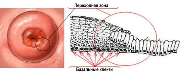 Незрелый метаплазированный эпителий